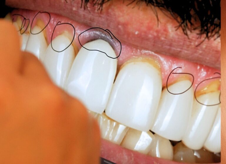 Blog 1 Why gums recede