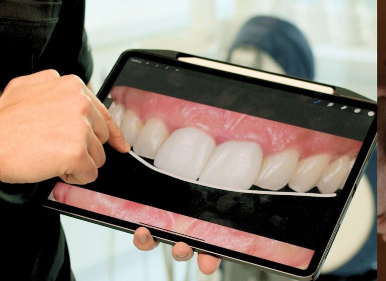 Blog 3 Do dental veneers always require shaving the teeth